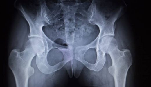 股関節レントゲンの骨嚢胞は手術のサイン？