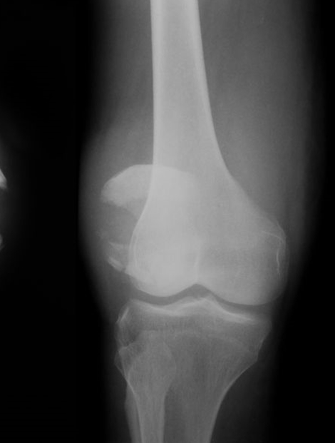 膝蓋骨脱臼骨折2