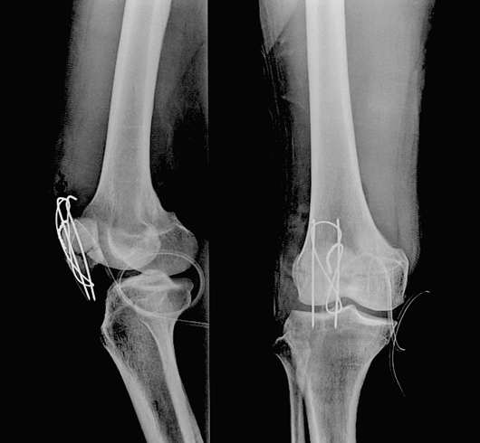 膝のお皿が割れる 膝蓋骨骨折と治療 リハビリについて解説します 股関節の痛みの原因を治療する