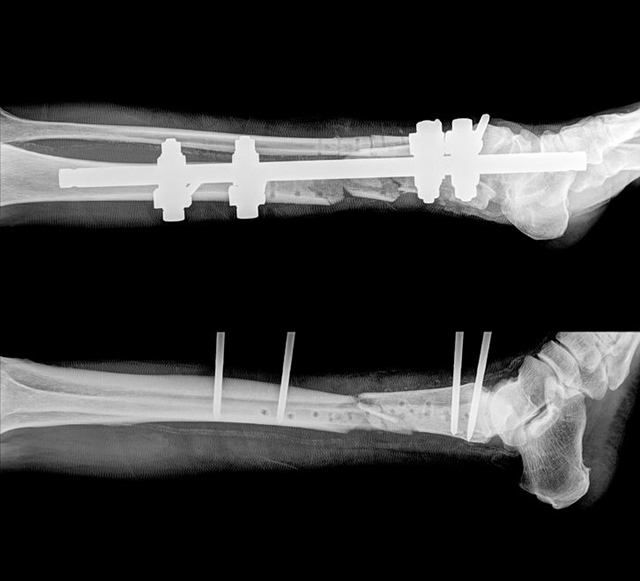 脛骨骨折の分類と手術、リハビリについて部位別に詳しく紹介します