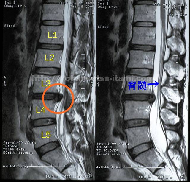 腰椎椎間板ヘルニア脊髄圧迫MRI